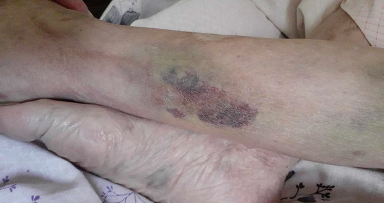 "Връзвана с колани и бинтове": Приключи проверката за оковаваната във Видинска болница столетница